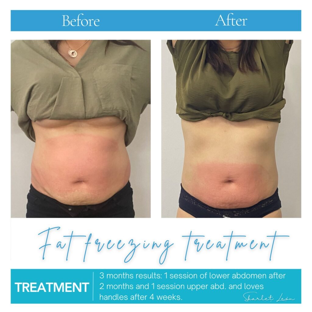 Coolsculpting Fat Freezing