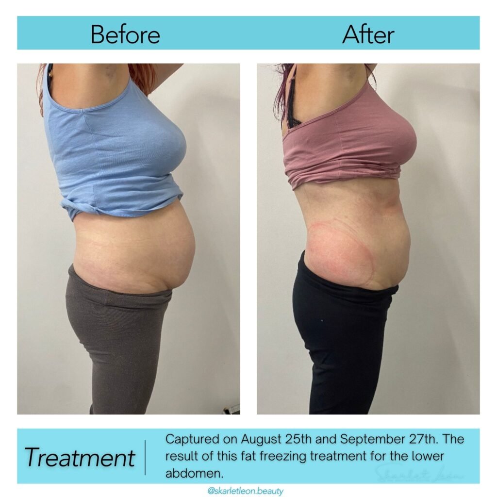 Fat Freezing Treatment