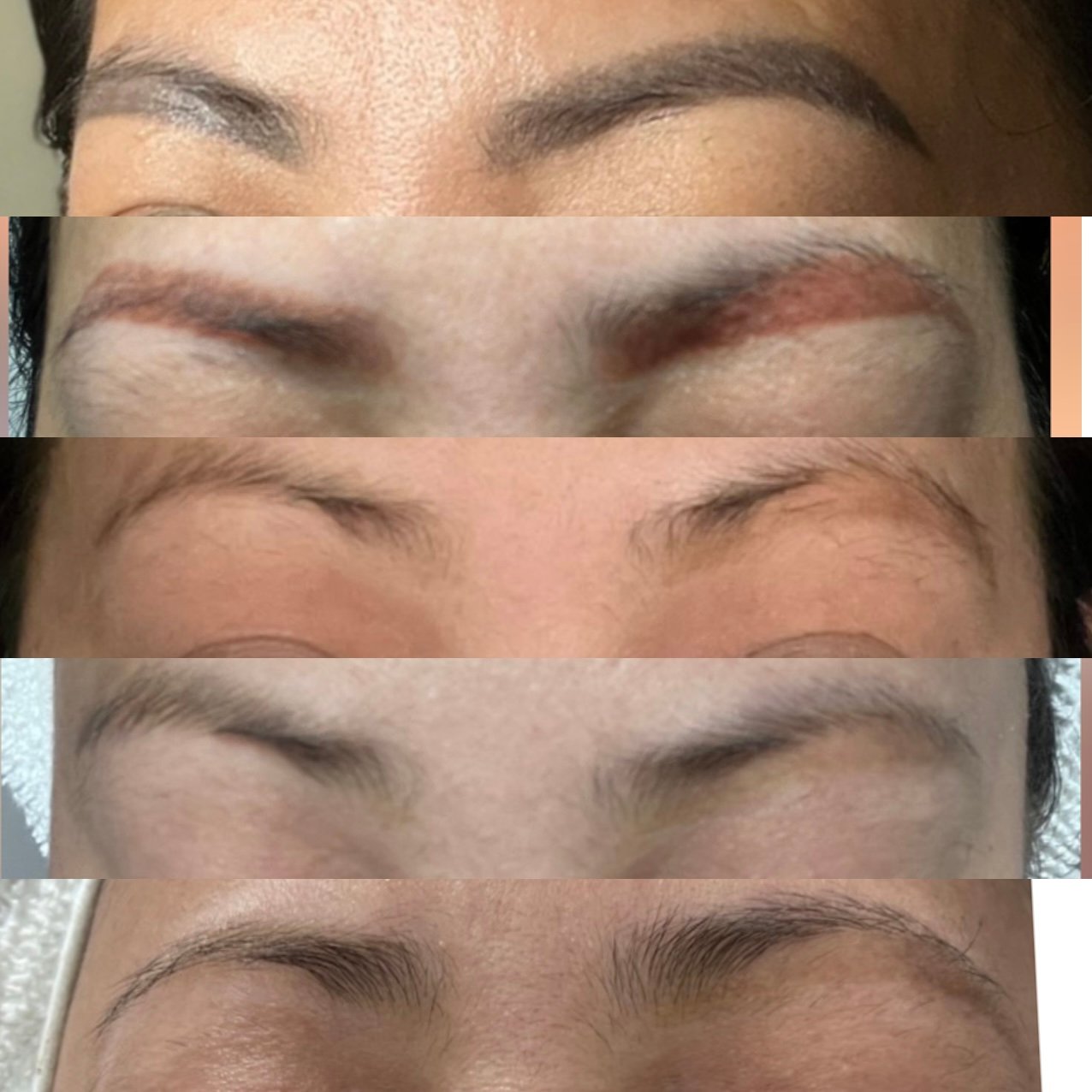 PMU brow tattoo removal progression — Skarlet Leon Bournemouth — colour change from dark to red across four sessions