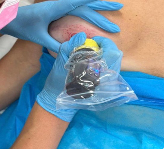 Areola nipple restoration tattoo Bournemouth