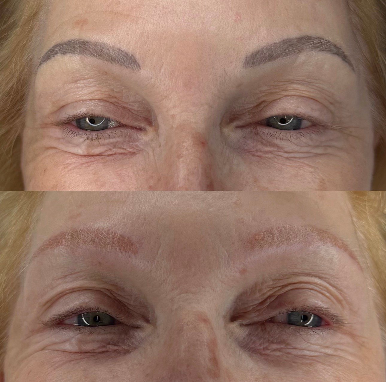 Redness and colour change immediately after laser removal session — Skarlet Leon Bournemouth