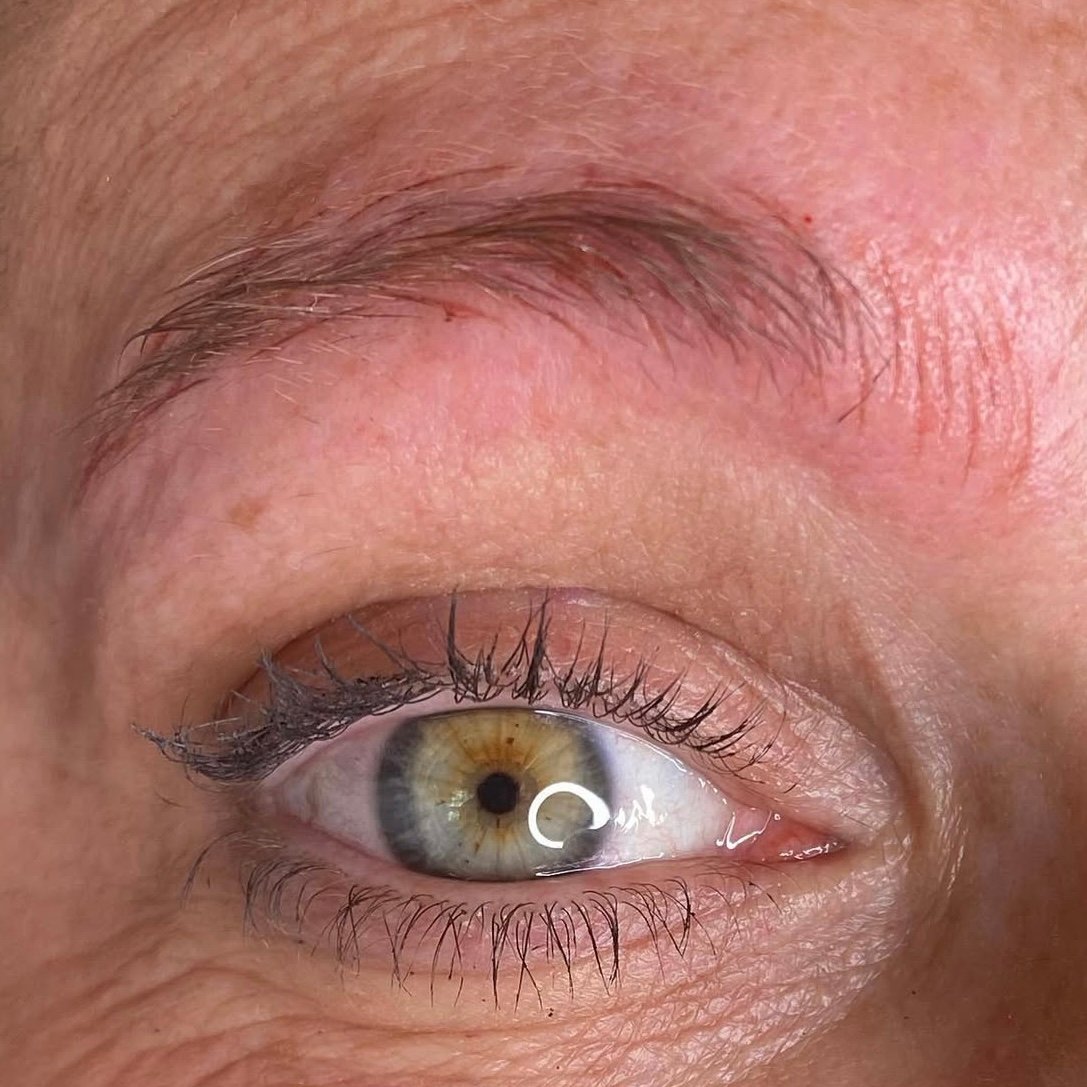During emergency removal — pigment lifting