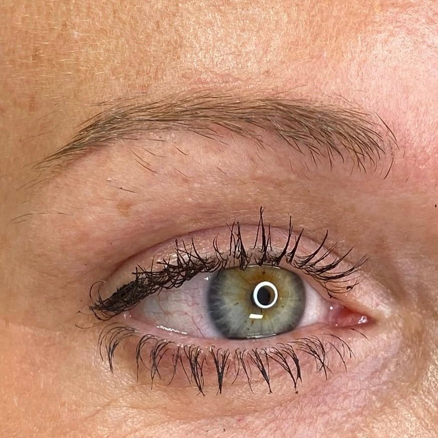 Healed skin after emergency saline removal — Skarlet Leon Bournemouth
