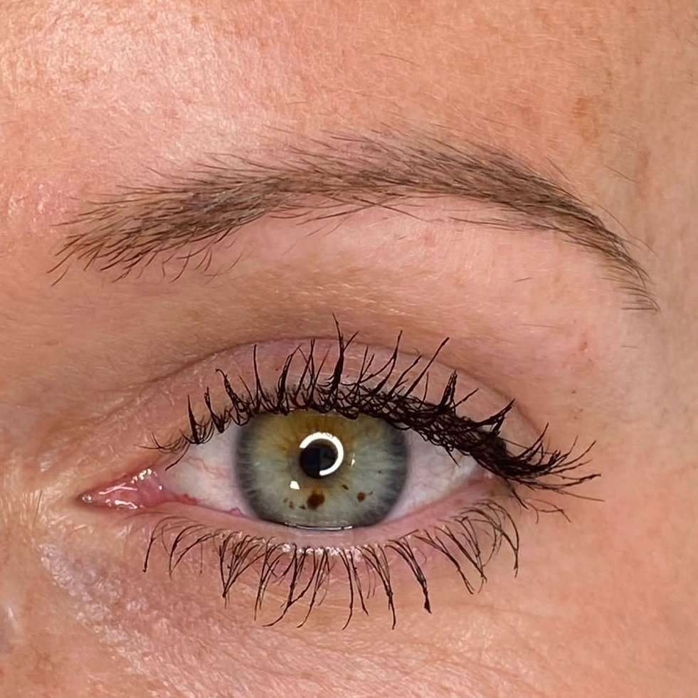 Final healed result after emergency removal