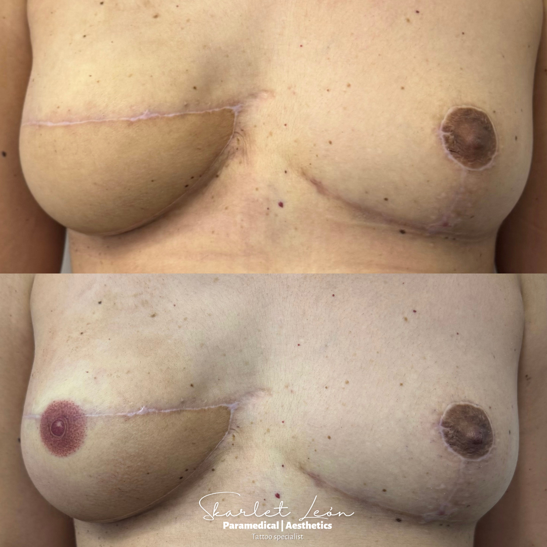 Client chose tattoo over surgery — avoided skin graft from vagina — Skarlet Leon Bournemouth