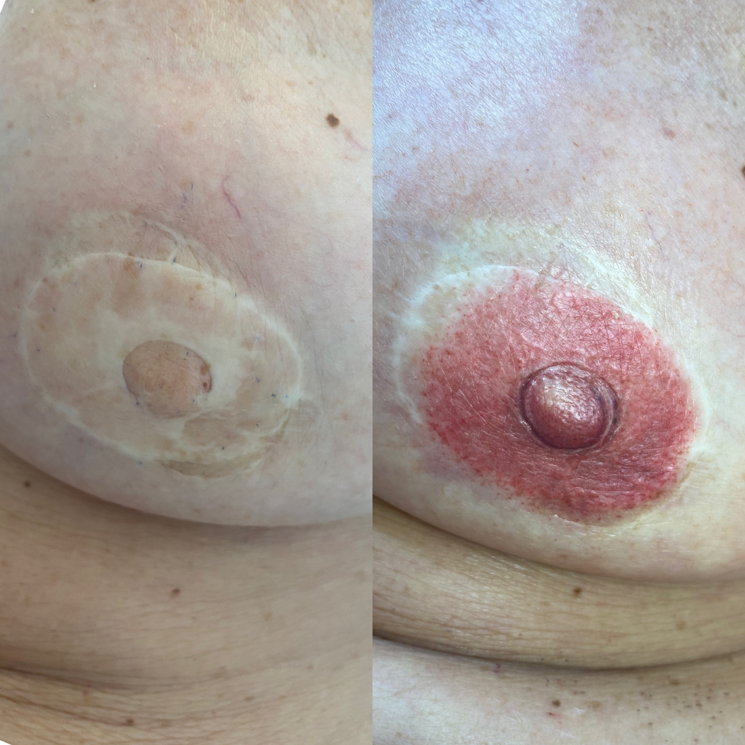 Client unhappy with surgical nipple graft — corrected with 3D areola tattoo — Skarlet Leon Bournemouth