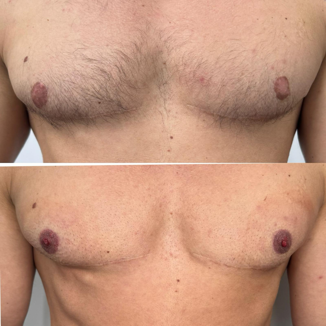 Gender affirmation areola tattoo — improving surgical result — Skarlet Leon Bournemouth